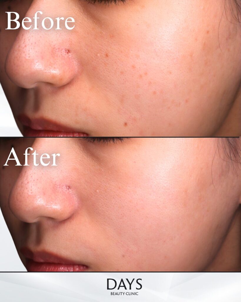 ディスカバリーピコ-ピコトーニング-の症例　20代女性